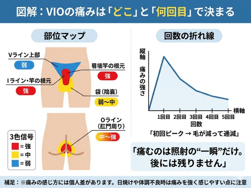 VIOの痛みは「部位」と「回数」の2軸で変わることを示す痛みマップ